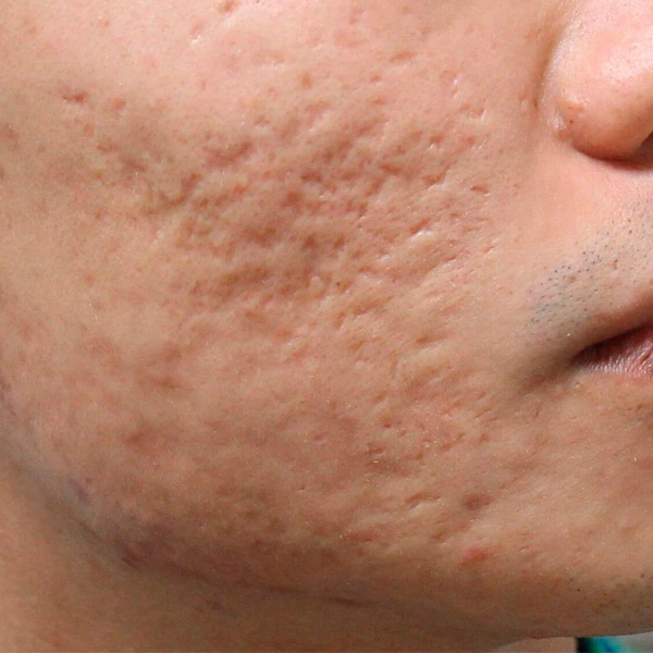 cicatrices de acne