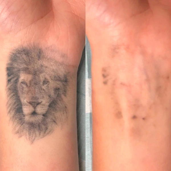 eliminación de tatuajes