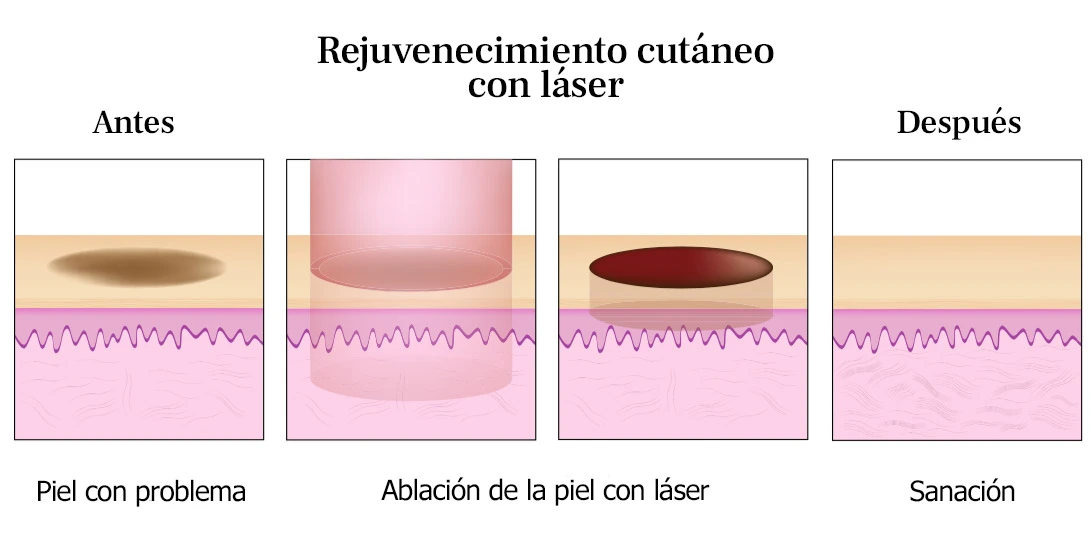 laser secuelas de acné